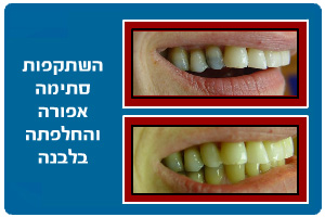 אפור לעומת לבן