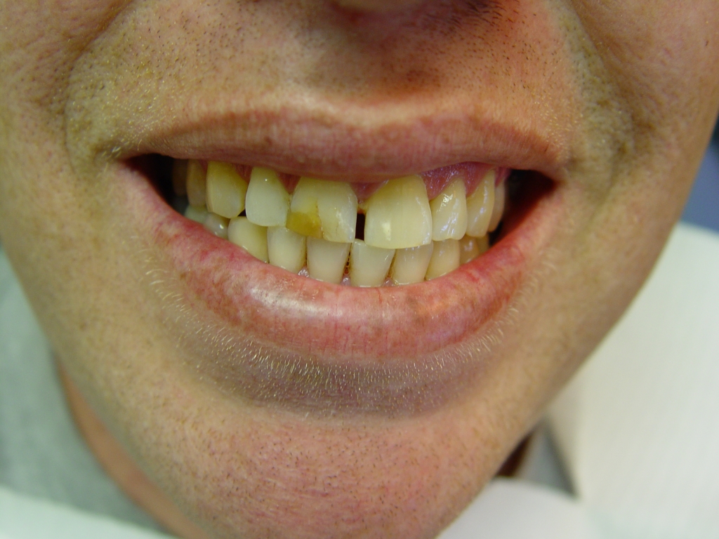 לפני: סתימה לבנה לא יפה