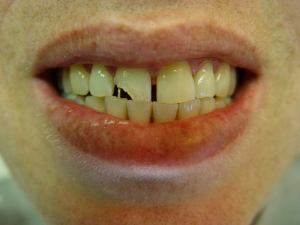 פין (יתד) לתמיכה