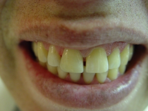 אחרי: תוצאה אסתטית וחזקה שיכולה להחזיק שנים רבות