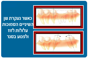 כתרים וגשרים