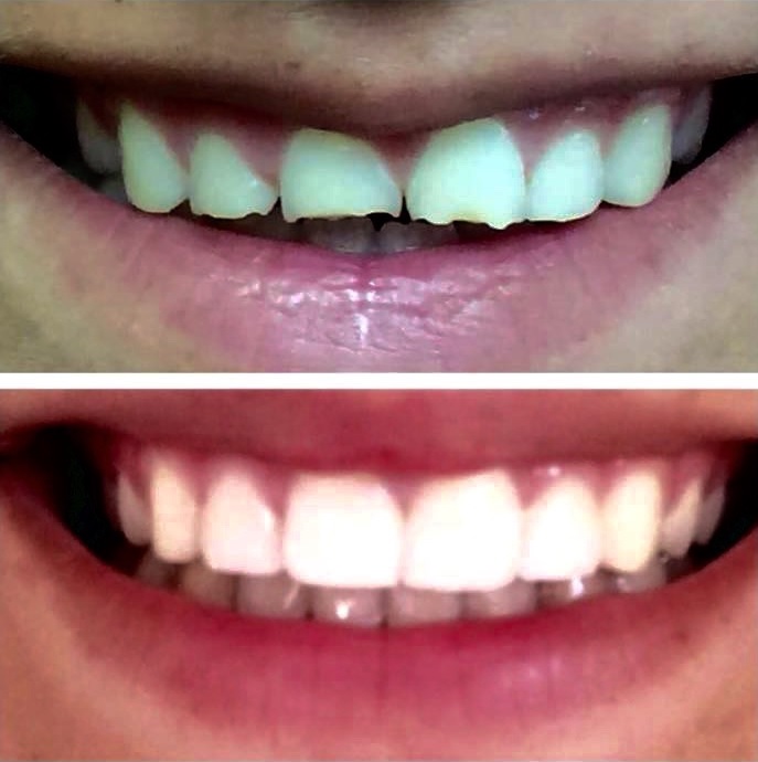 ציפויי שיניים - לפני ואחרי