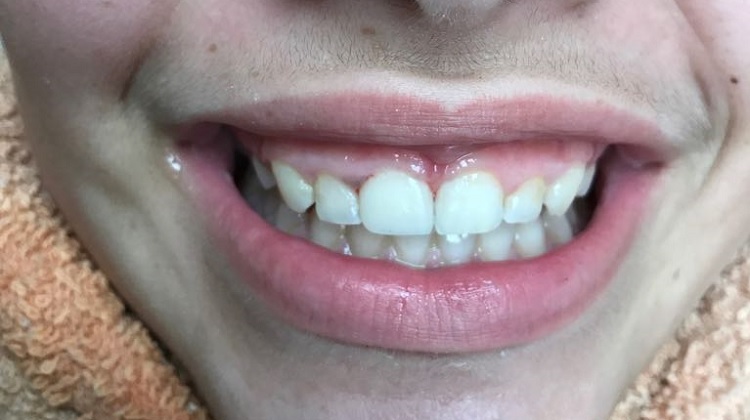 שן שבורה-אחרי