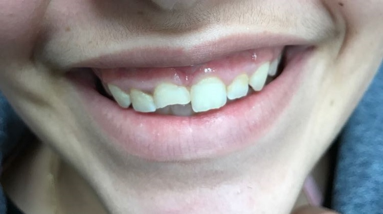 שן שבורה-לפני